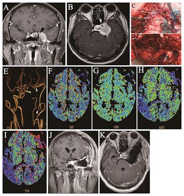 Maximal Resection of Tumors Encasing the Internal Carotid Artery and Hindering Internal Carotid Artery Expansion Followed by Revascularization Surgery: A Series of Nine Cases at a Single Tertiary Center